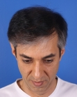 After Hair Transplant&nbsp;2 Sessions (Areas)
